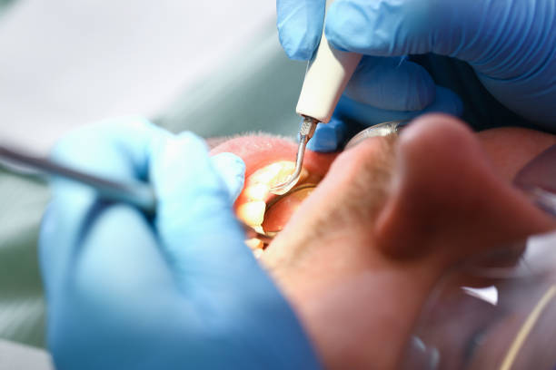 Best Emergency Root Canal Therapy in Gilbert, AZ